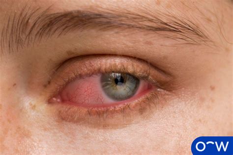Shingles On Eyeball