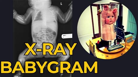 Should Babies Have X Rays