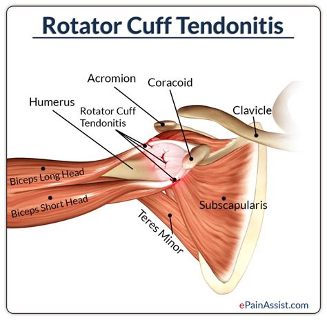 Shoulder Tendonitis Treatment