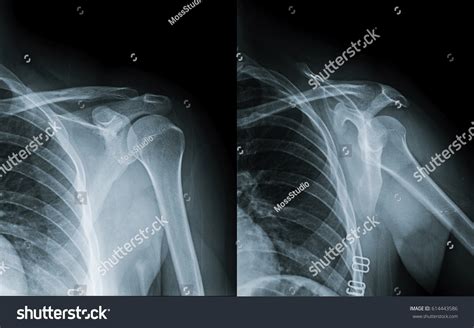 Shoulder X Ray