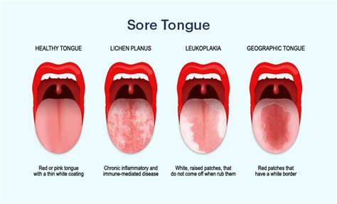 Side Of Tongue Hurts