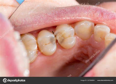 Side Of Tooth Decay
