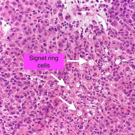 Signet Ring Cell Carcinoma