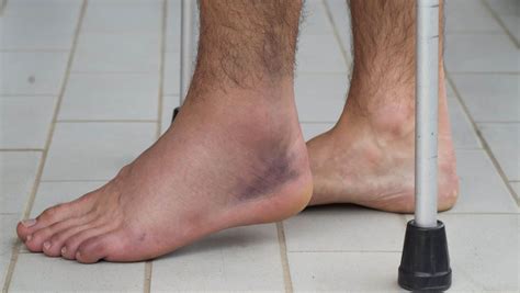 Signs Of A Broken Foot