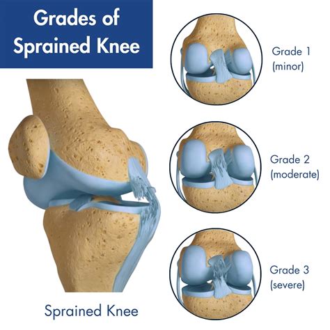 Signs Of A Sprained Knee