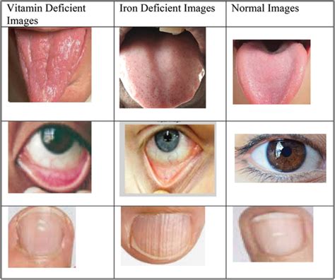 Signs Of Low Iron Eyes