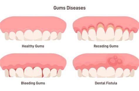 Signs Of Receding Gums