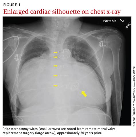 Silhouette Of Heart X Ray