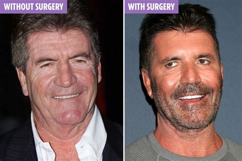 Simon Cowell Face Surgery