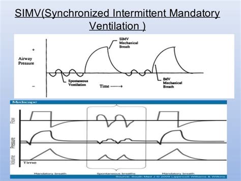 Simv Mode Of Ventilator