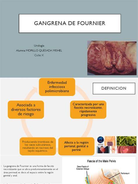 Sindrome De Fournier