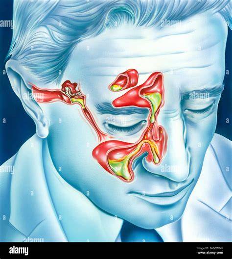 Sinus And Ear Infection