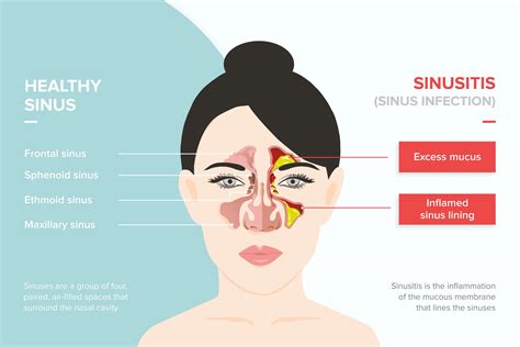 Sinus Infection Bloody Nose