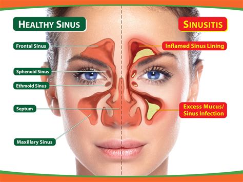 Sinus Infection Does It Affect Eyes