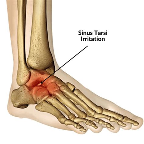Sinus Tarsi Syndrome