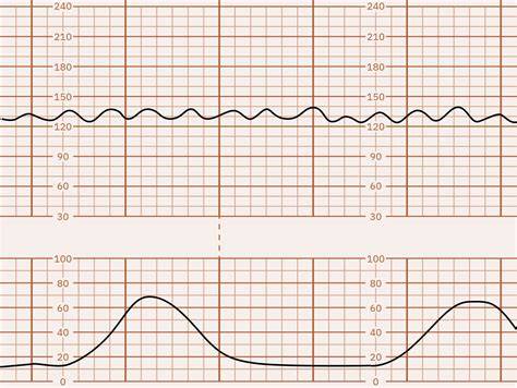 Sinusoidal Fetal Heart Rate