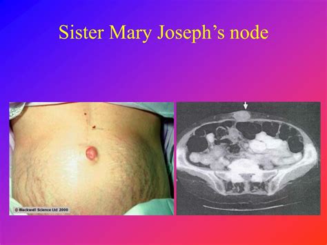 Sister Mary Joseph Node