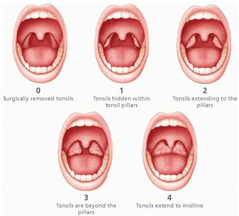 Size Of Tonsil
