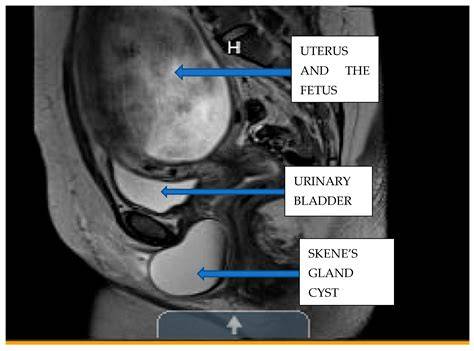 Skene Gland Cysts