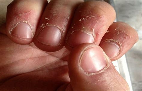 Skin Around Nails Peeling