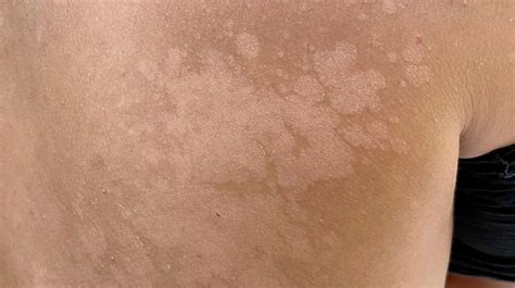 Skin Cancer On Boob