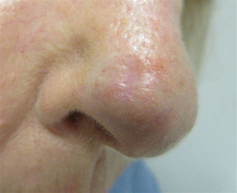 Skin Cancer On Nose