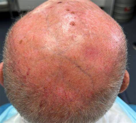 Skin Cancer On Scalp