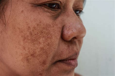 Skin Discoloration On Face