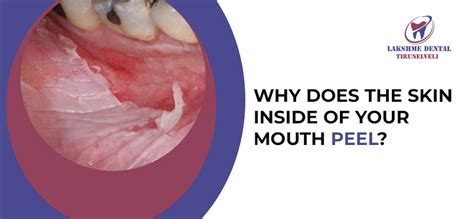 Skin Peeling In Mouth