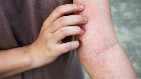Skin Rashes Kidney