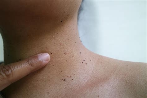 Skin Tags On Neck Causes