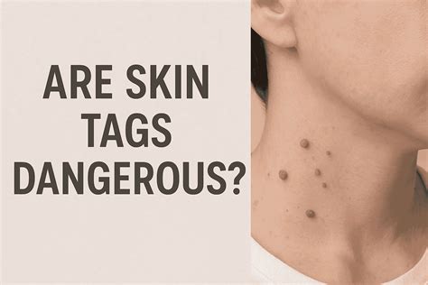 Skin Tags On Penius