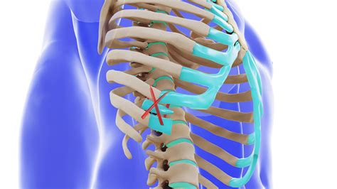Slipping Rib Syndrome Treatments