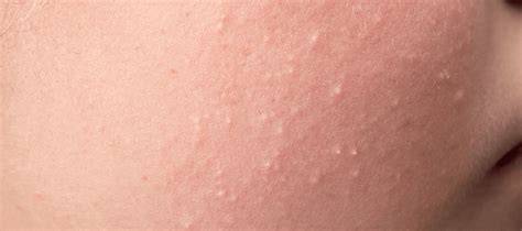 Small Bumps Face Not Acne