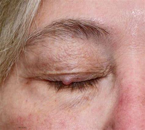 Small Lumps In Eyelid