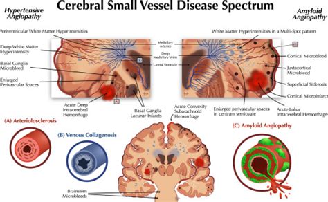 Small Vessel Disease