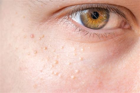 Small White Bump On Face