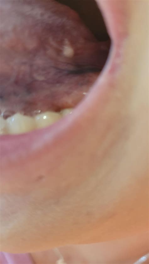 Small White Bump On Tongue