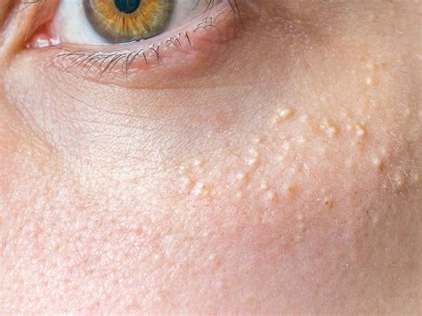 Small White Bumps On Face