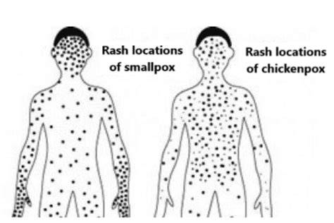 Smallpox Does It Still Exist