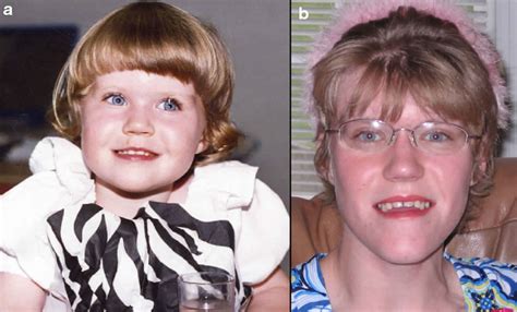 Smith Syndrome Disease