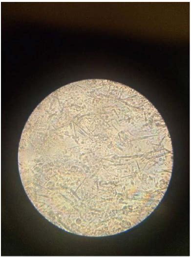 Sodium Urate