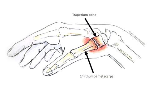 Sore Base Of Thumb