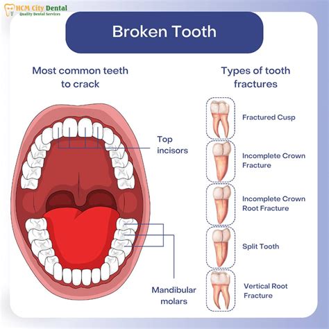 Sore Cracked Tooth