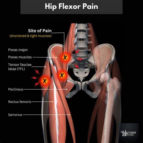 Sore Hip Flexors