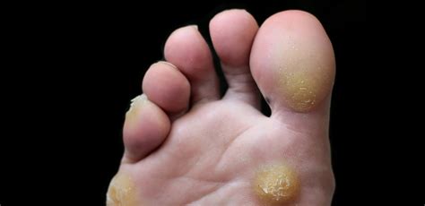 Sore Lump On Foot Sole