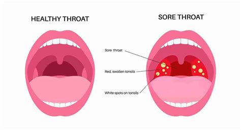 Sore Throat Vs Normal