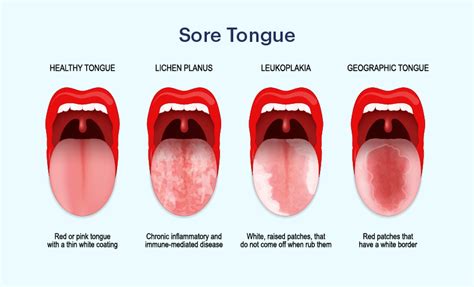 Sore Tongue Back