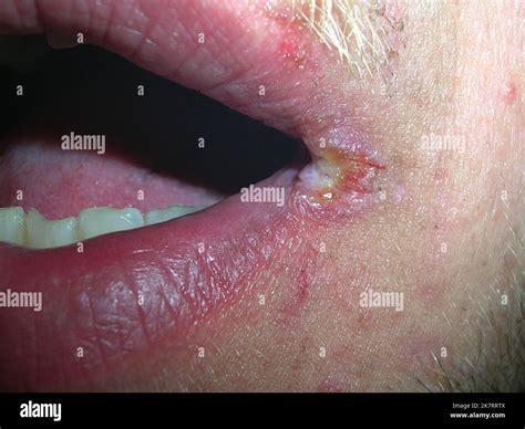 Sores In Corner Of Mouth