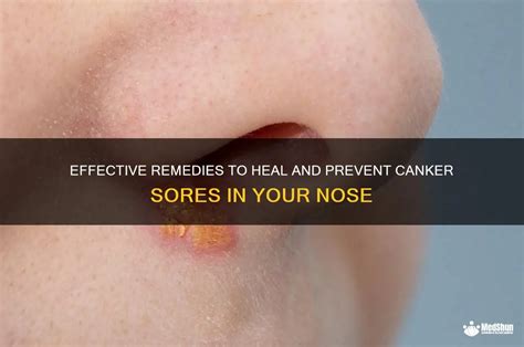 Sores In Your Nose